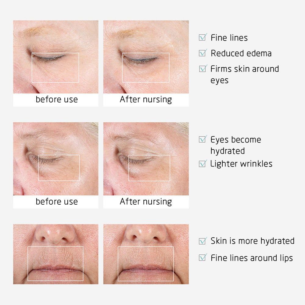 Eye and Lip Anti Aging Device