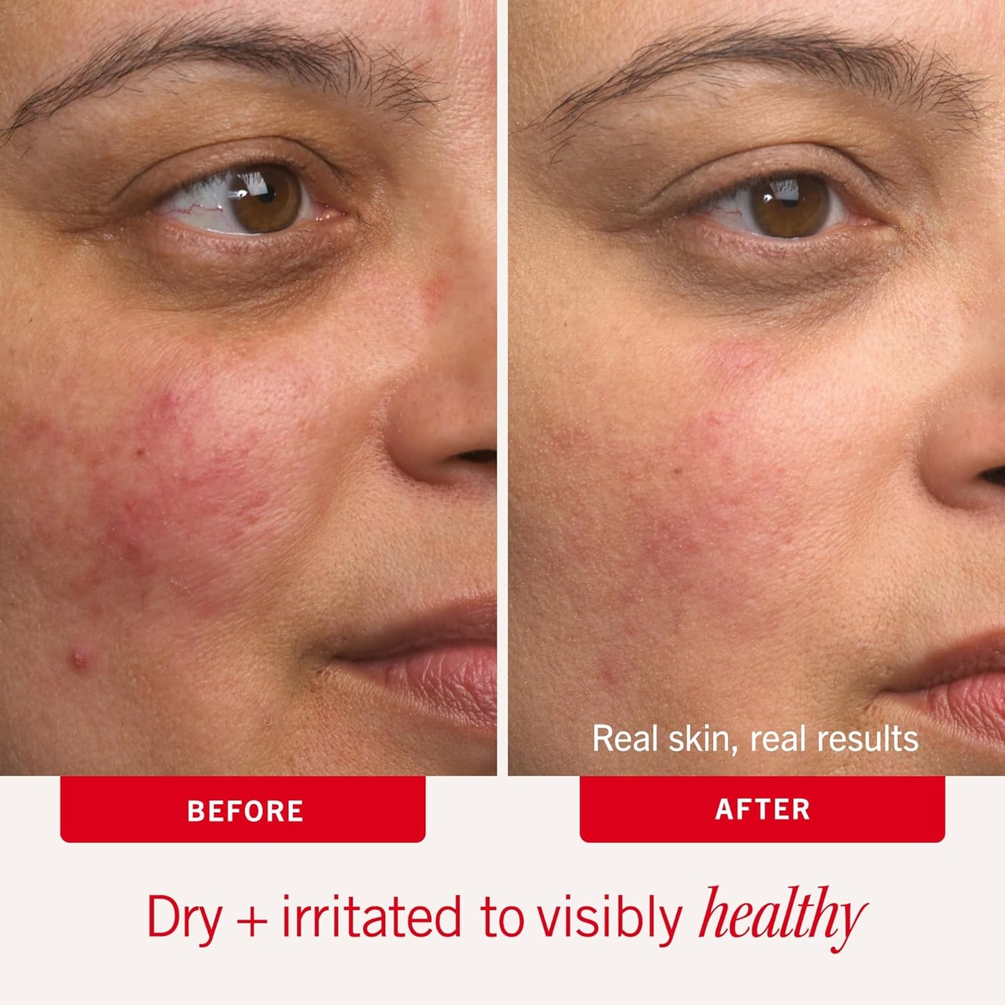 - Ultra Repair Cream - Intense Hydration Face & Body Moisturizer - Whipped Colloidal Oatmeal Clinically Proven to Strengthen Skin Barrier in 7 Days - Helps Relieve Eczema, 6 Oz